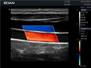 Système d’échographie diagnostique Acclarix LX3 – EDAN