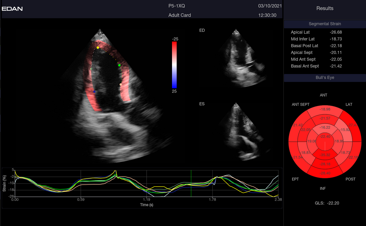 Système d’échographie diagnostique Acclarix LX9 – EDAN