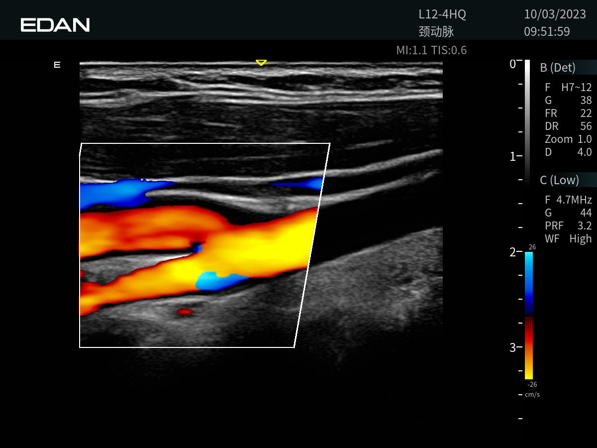 EDAN Acclarix AX9 - Échographe diagnostique portable